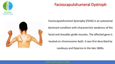 Facioscapulohumeral Dystrophy FSHD • Easy Explained - OrthoFixar 2022 ...