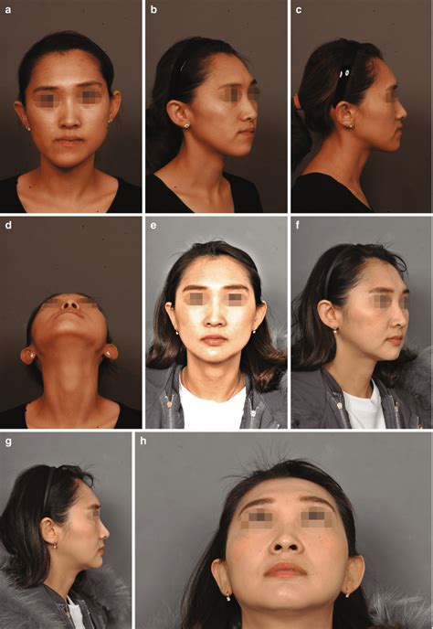 Application of the Surgery-First Approach to Facial Asymmetry | Pocket ...