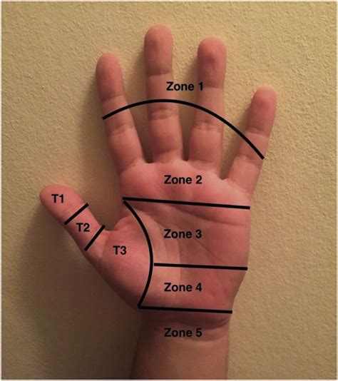 The anatomical zones of tendon injuries (Verdan). T1 = thumb zone 1, T2... | Download Scientific ...