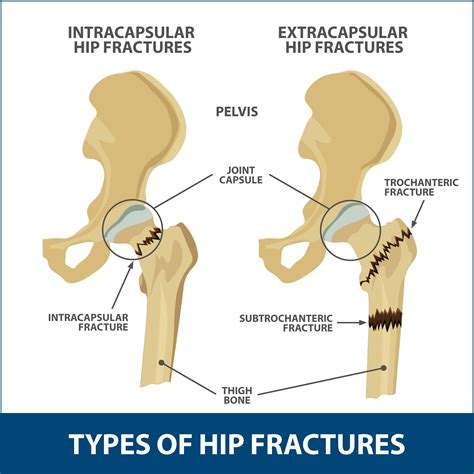 Hip Bone Fracture