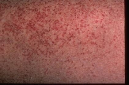 What Causes Little Red Dot on the Skin? | New Health Advisor