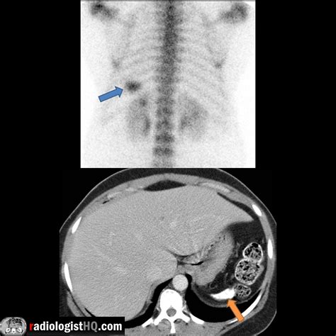 Bone scan & CT of calcified spleen in sickle cell disease : Radiology