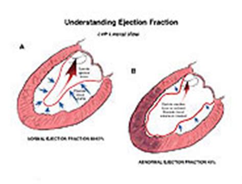 Understanding Ejection Fraction Medical Exhibit Medivisuals