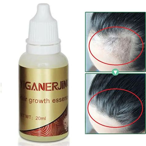 1pcs Anti Hair Loss Oil Products Organic Fast Hair Growth Essence Liquid Hair Loss Treatment ...