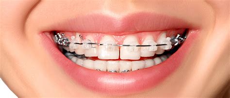 7 Tips to Prevent Ceramic Braces From Staining