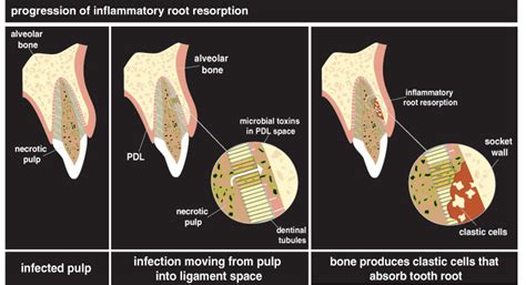 Endodontic Treatment of Reimplanted Avulsed Teeth - Dentistry Today