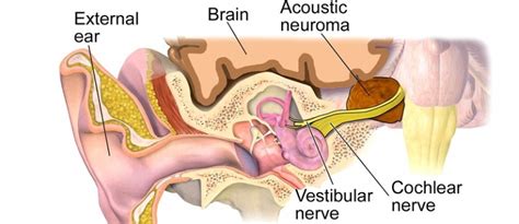 Acoustic Neuroma Symptoms, Causes, Diagnosis and Treatment - Natural ...