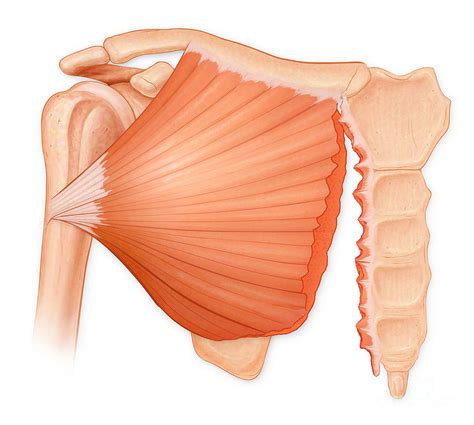 Pectoralis Major Tendon Tear