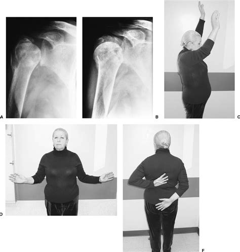 Complications of Proximal Humeral Fractures | Musculoskeletal Key