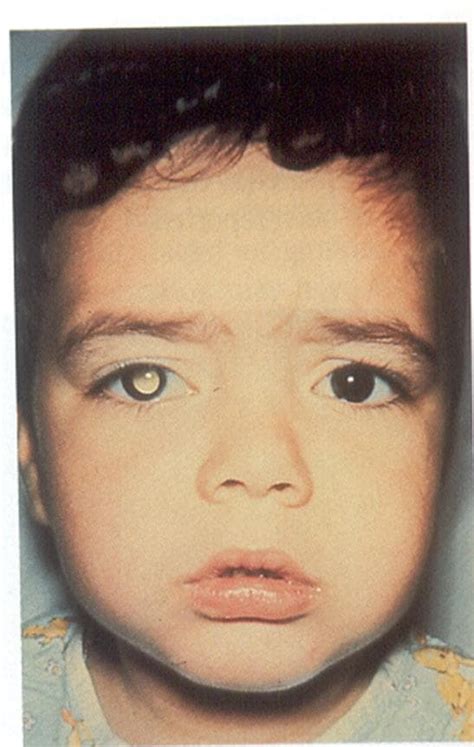 Retinoblastoma - Eye specialist, Treatments for Retinoblastoma Gurgaon