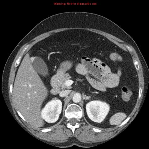 Adenomyomatosis - fundal | Image | Radiopaedia.org