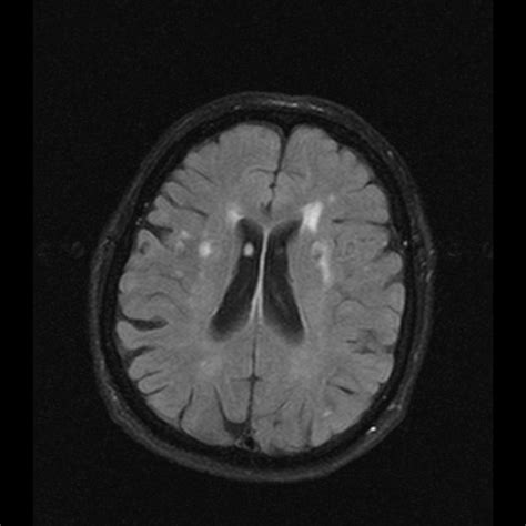 FAZEKAS scale | STROKE MANUAL