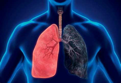 Asbestosis | Background, Causes, Symptoms, and Treatments