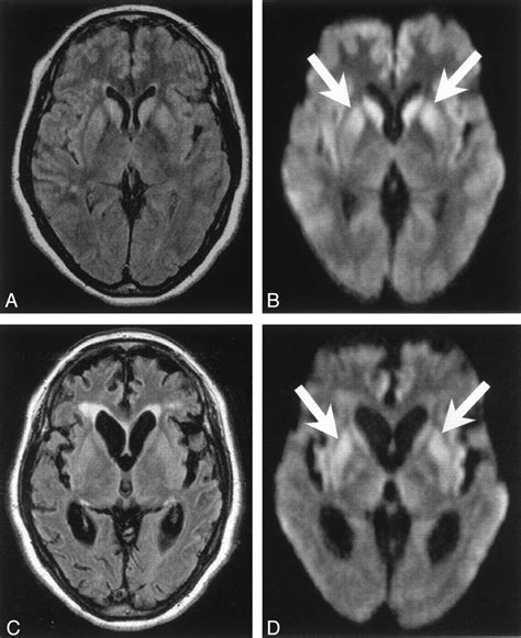 Creutzfeldt-Jakob disease. Causes, symptoms, treatment Creutzfeldt-Jakob disease