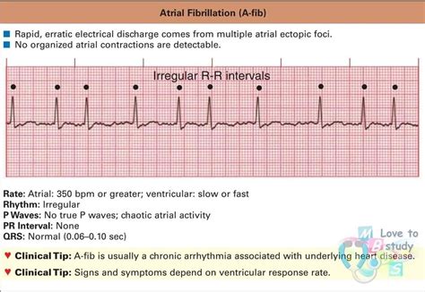 Er Rn, Pr Interval, P Wave, Cardiac Nursing, Atrial Fibrillation, Contractions, Ekg, Cardiology ...