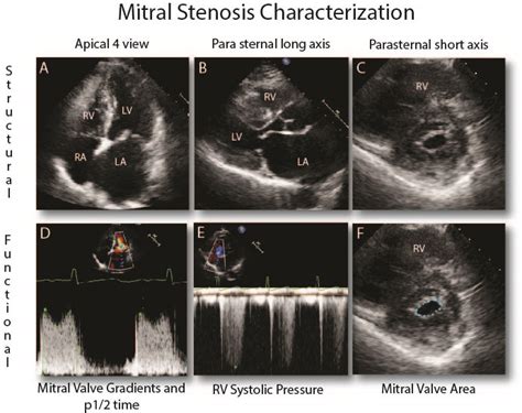 Real-Time 3D Echocardiography in Percutaneous Balloon Mitral Valvuloplasty | IntechOpen