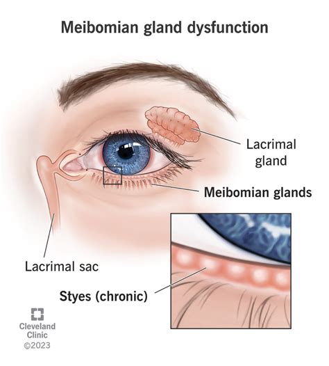 Meibomian Gland Dysfunction: Symptoms & Treatment