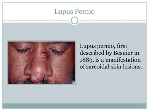 Lupus Pernio