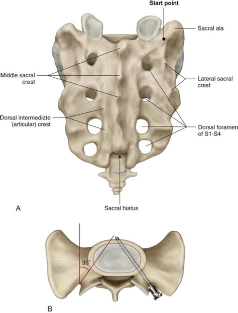 Sacral Screw Fixation and Plating Techniques | Neupsy Key