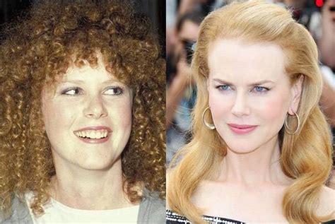 Nicole Kidman and her plastic surgery procedures