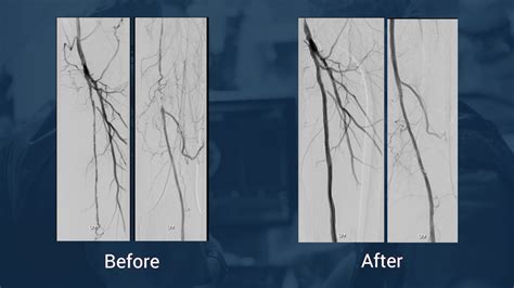 Video : Drug eluting stent for challenging long SFA lesion