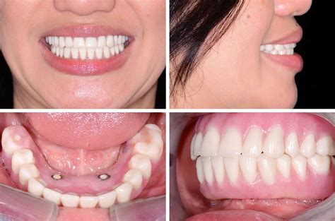 Immediate Implants on Mandible and Teeth All-On-4 - Dental Implants ...