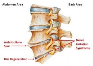 spinal-osteoarthritis - Cawley Physical Therapy