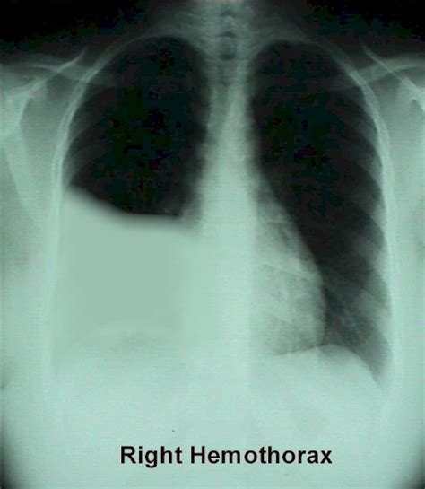 Right lung hemothorax caused by gunshot wound to the chest