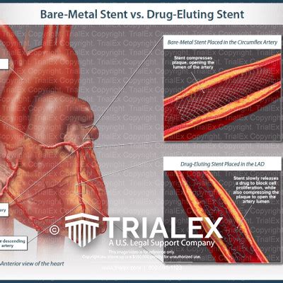 Bare-Metal Stent vs Drug-Eluting Stent - TrialExhibits Inc.