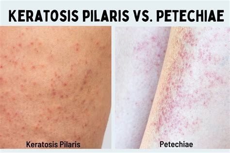 Petechiae vs. Keratosis Pilaris: What is the Difference?