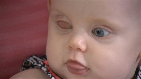 'Red eye' in baby photos alerts parents to tumor - Arizona's Family