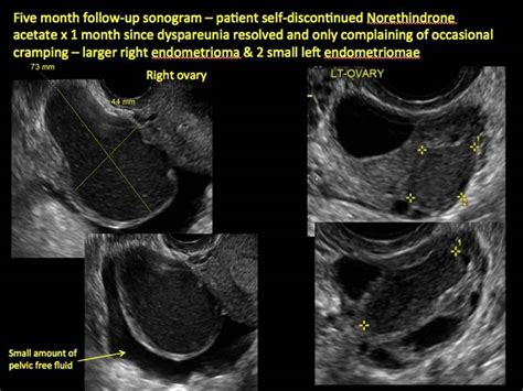 Imaging the endometrioma and mature cystic teratoma | MDedge ObGyn