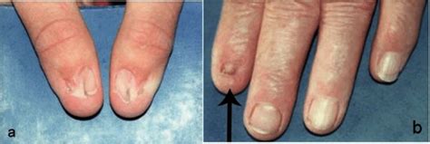 Nail-patella syndrome: MedlinePlus Genetics