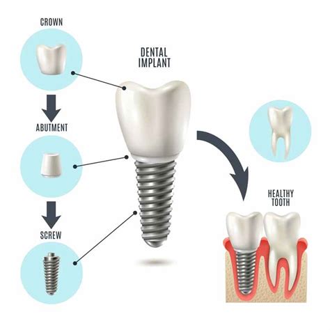 Dental Implants In Bangalore | Treatment From the Experts