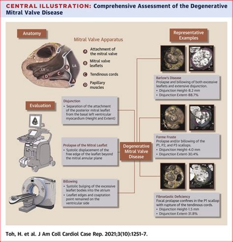 Varied Extent of Mitral Annular Disjunction Among Cases With Different Phenotypes of Mitral ...