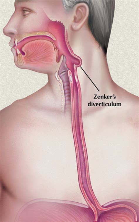 Zenker Diverticulum | Semantic Scholar