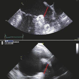 (PDF) Left atrial appendage closure monitoring without sedation: A ...