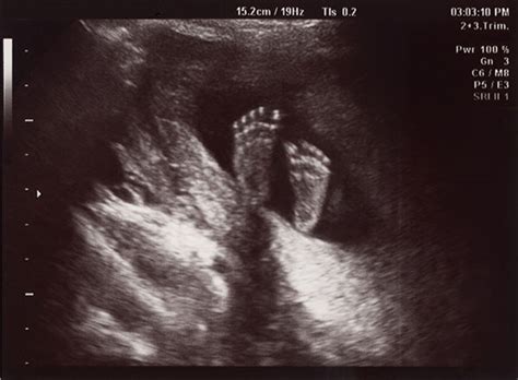 Baby In Uterus Ultrasound