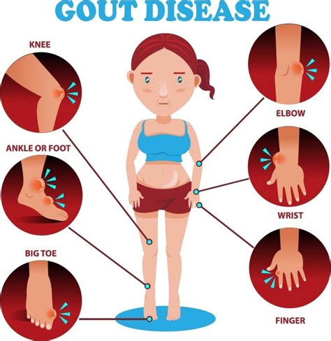 Ghim trên Gout Causes