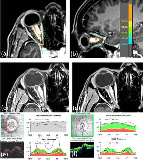 Long-term treatment outcomes of patients with primary optic nerve ...