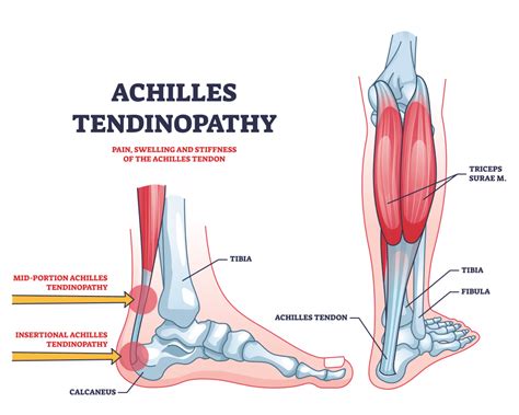 Plantaris Tendon And Association With Mid Portion Achilles Tendinopathy | Images and Photos finder