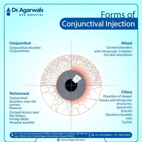 Ciliary Injection