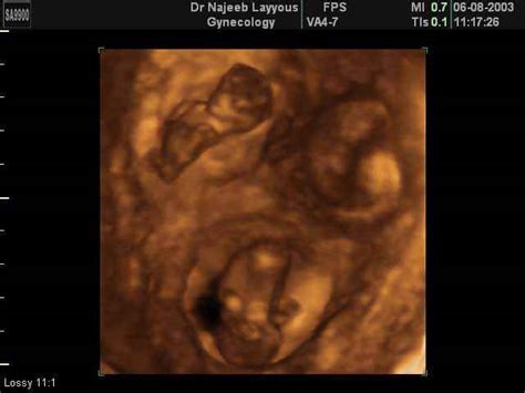 3D Ultrasound Scan photos of Multiple Pregnancy twins triplets ...