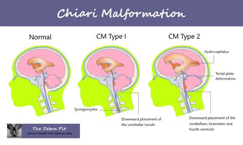 From Chiari Malformation: What You Need to Know – The Zebra Pit Diagram shows three pictures of ...