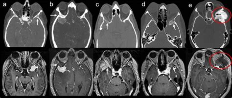 Classification of bone involvement in sphenoid wing meningiomas based... | Download Scientific ...