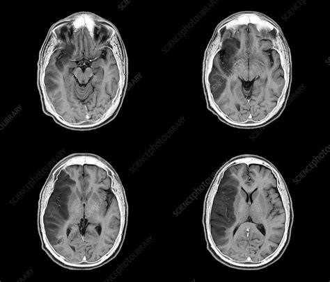 Stroke, MRI brain scans - Stock Image - C037/1590 - Science Photo Library