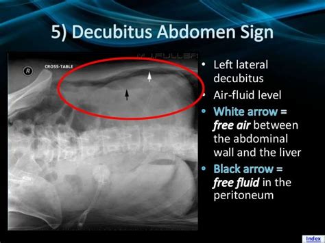 Pneumoperitoneum | Abdominal, Abdomen, Black arrows