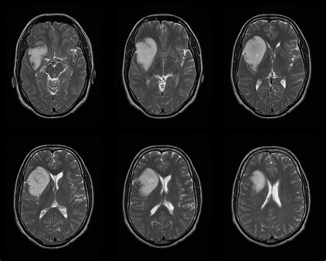 Dr Balaji Anvekar FRCR: Anaplastic Astrocytoma MRI