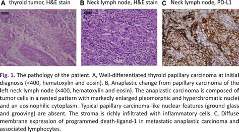 Anaplastic Thyroid Cancer Successfully Treated With Radiation and ...