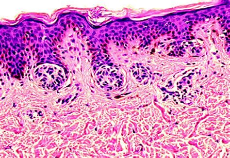 Congenital Melanocytic Nevus Histology